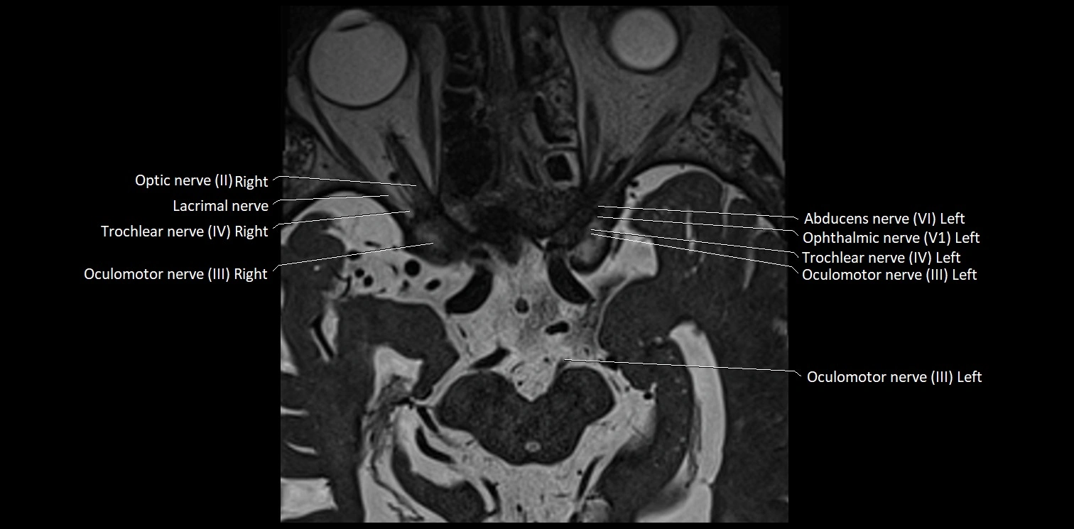 Cranial nerve anatomy axial MRI 3T image 16.webp